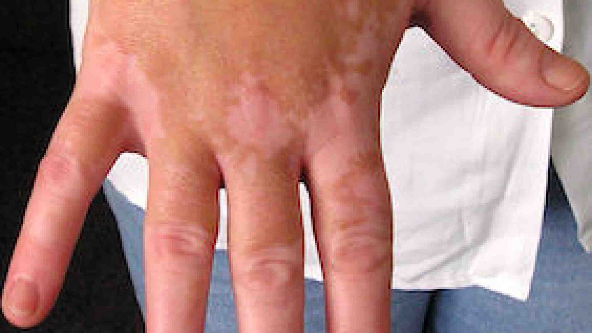 La vitiligine, male della pelle che fa male pure all’animo