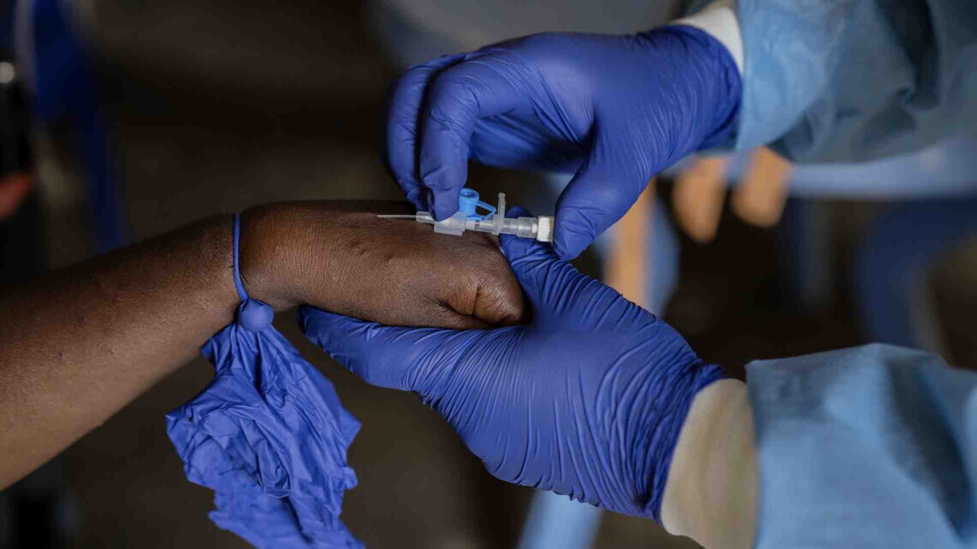 Il nuovo virus Mpox e la strada per far arrivare i vaccini dove servono