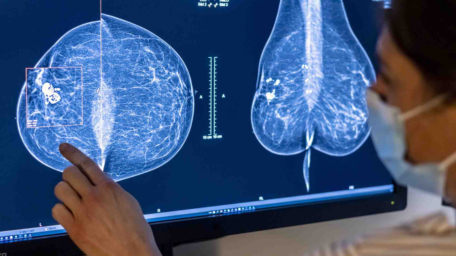 Dottor IA: come migliorare la diagnosi di cancro al seno con l'intelligenza artificiale