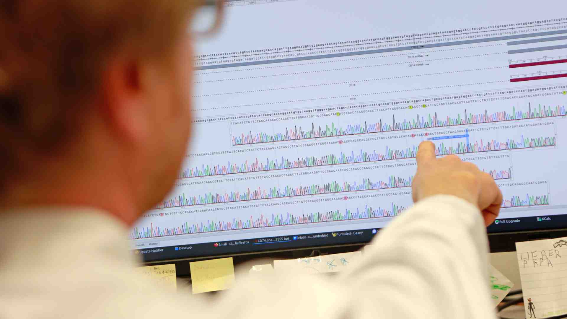 Lo screening genetico di popolazione è fattibile, ma c'è il rischio della sovradiagnosi strutturale